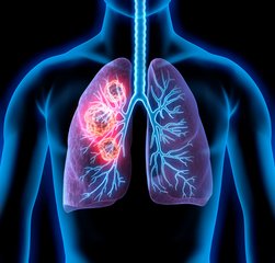 Neues schonendes Verfahren bei der Lungenspiegelung zur früheren Entdeckung von Lungenkrebs